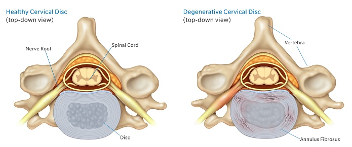 Degenerative Cervical Spine Mobi-C Procedure by Dr. Martin Spine Surgeon Houston | Houston Spine Dr. Martin | (281) 653-2686 | Houston Spine Surgeon Board Certified | Next Day Appointment