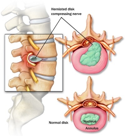 Herniated Disc Symptoms & Treatment Options | Houston Spine Dr. Martin | (281) 653-2686 | Houston Spine Surgeon Board Certified | Next Day Appointment