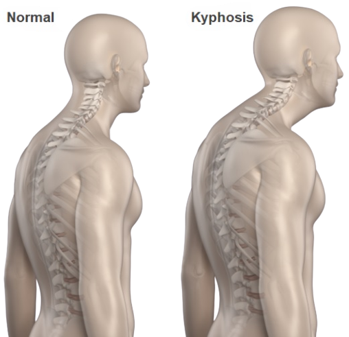 Kyphosis Treatment Dr Martin Spine Surgeon