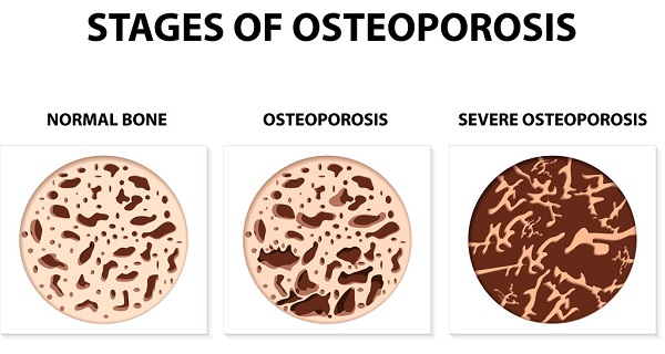 Osteoporosis Symptoms & Treatment Options | Houston Spine Dr. Martin | (281) 653-2686 | Houston Spine Surgeon Board Certified | Next Day Appointment