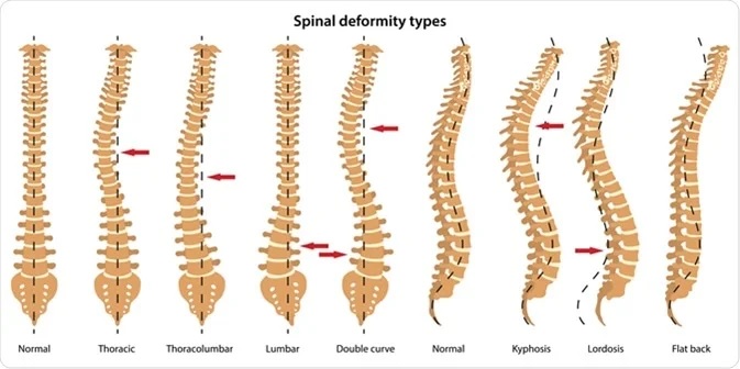 Spinal Deformities Symptoms & Treatment Options | Houston Spine Dr. Martin | (281) 653-2686 | Houston Spine Surgeon Board Certified | Next Day Appointment