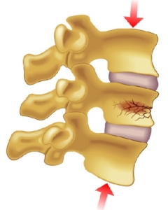 Spinal Fractures Symptoms & Treatment Options