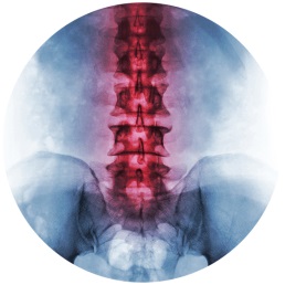 Ankylosing Spondylitis Symptoms & Treatment | Houston Spine Dr. Martin | (281) 653-2686 | Houston Spine Surgeon Board Certified | Next Day Appointment