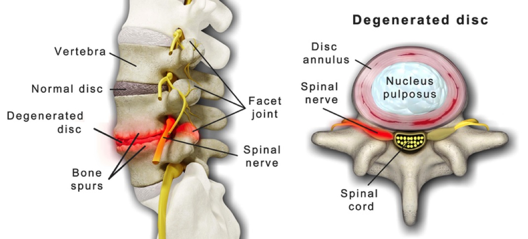 Finding Relief from Degenerative Disc Disease By Expert Spine Surgeon in Houston